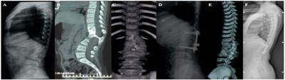 Analysis of therapeutic effects of congenital kyphosis in children due to anterior vertebral bone bridges